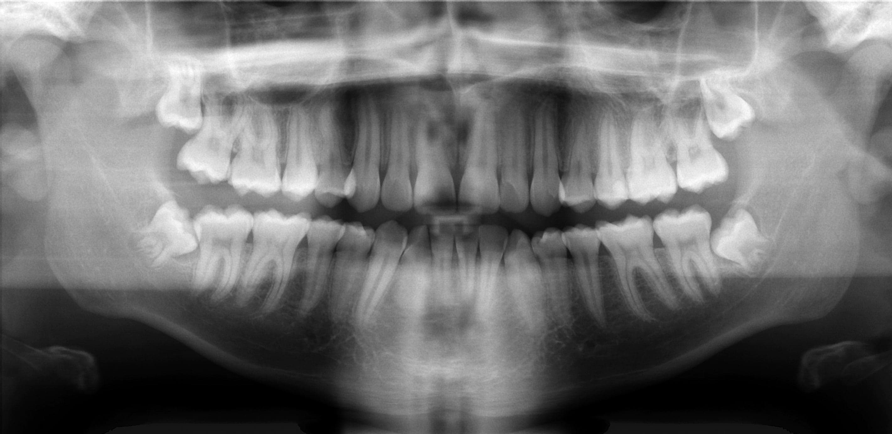 Exemplo de radiografia panor&acirc;mica odontol&oacute;gica mostrando vis&atilde;o completa das arcadas dent&aacute;rias