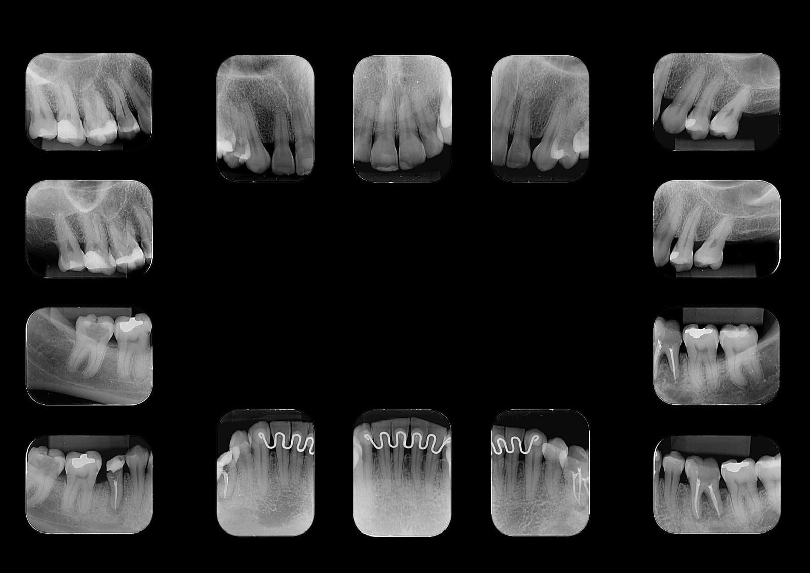 Levantamento periapical completo com 14 radiografias intraorais digitais boca toda - Radix Taquaritinga