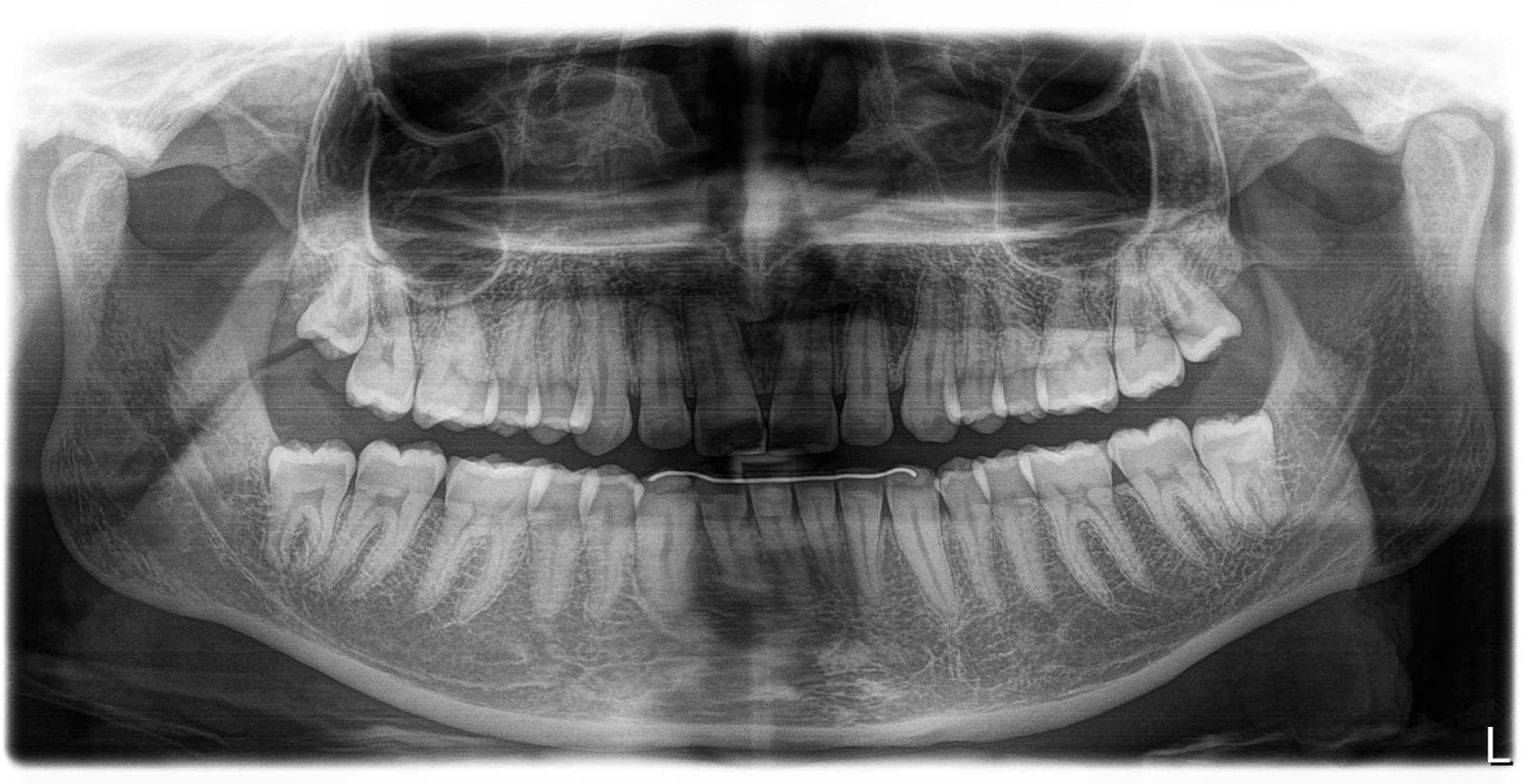 Radiografia panor&acirc;mica odontol&oacute;gica digital realizada na Radix Radiologia em Taquaritinga SP
