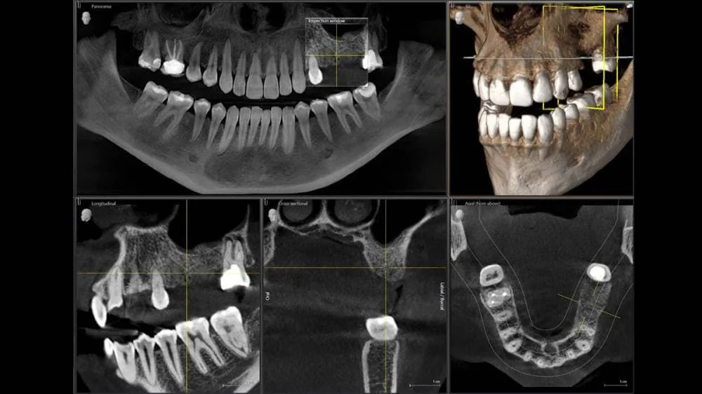 Imagem tridimensional 3D de tomografia computadorizada Cone Beam mostrando estruturas maxilofaciais detalhadas